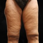Thigh Lift Before & After Patient #10847