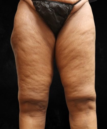Thigh Lift Before & After Patient #10847