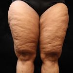 Thigh Lift Before & After Patient #10848