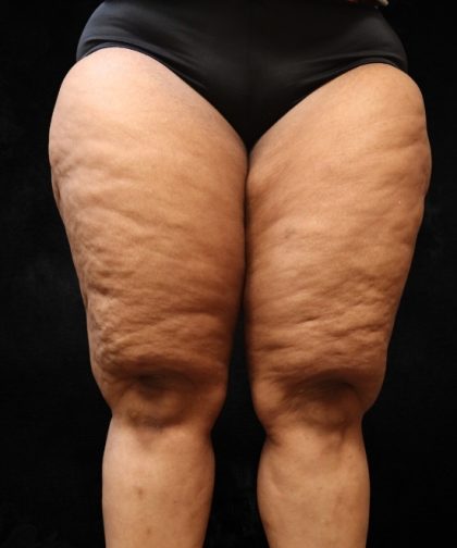Thigh Lift Before & After Patient #10848