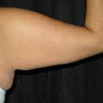 Arm Lift Before & After Patient #10812