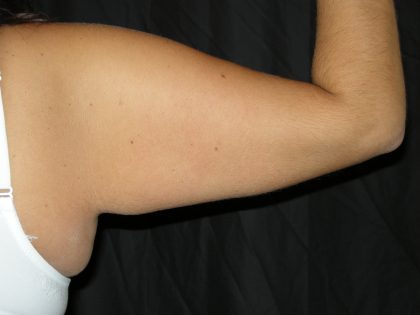 Arm Lift Before & After Patient #10812