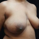 Breast Asymmetry Before & After Patient #10901