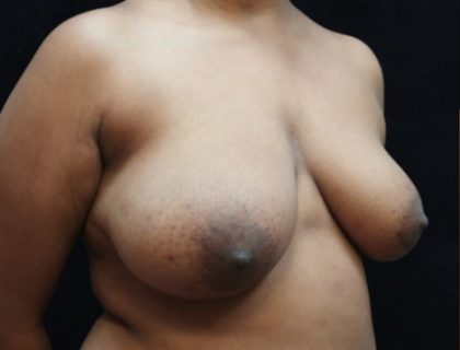 Breast Asymmetry Before & After Patient #10901