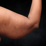 Arm Lift Before & After Patient #10814