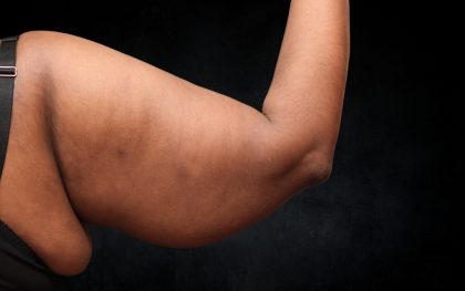 Arm Lift Before & After Patient #10814