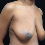 Breast Lift Before & After Patient #11044