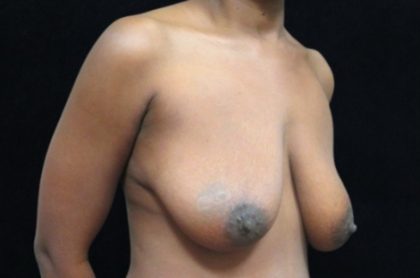 Breast Lift Before & After Patient #11044