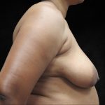Breast Lift Before & After Patient #11045
