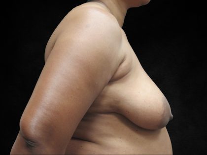 Breast Lift Before & After Patient #11045