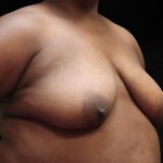 Breast Lift Before & After Patient #11049