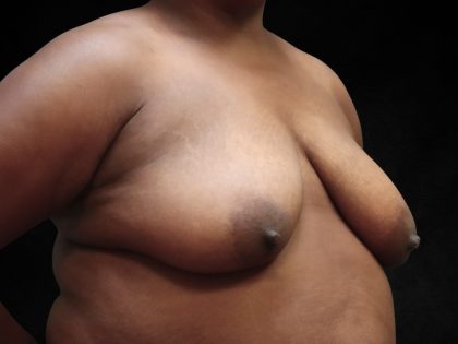 Breast Lift Before & After Patient #11049