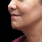 Scarless Facelift and Necklift Before & After Patient #11100