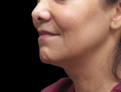 Scarless Facelift and Necklift Before & After Patient #11100