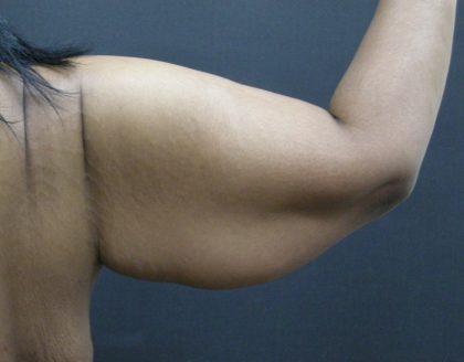 Arm Lift Before & After Patient #10813
