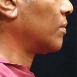 Scarless Facelift and Necklift Before & After Patient #11101