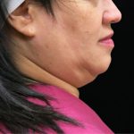 Scarless Facelift and Necklift Before & After Patient #11102