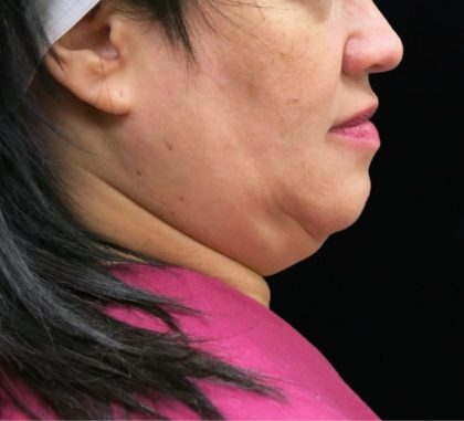 Scarless Facelift and Necklift Before & After Patient #11102