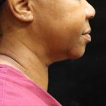 Scarless Facelift and Necklift Before & After Patient #11104