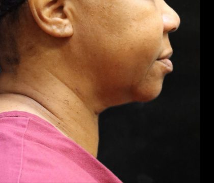 Scarless Facelift and Necklift Before & After Patient #11104
