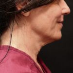 Scarless Facelift and Necklift Before & After Patient #11105