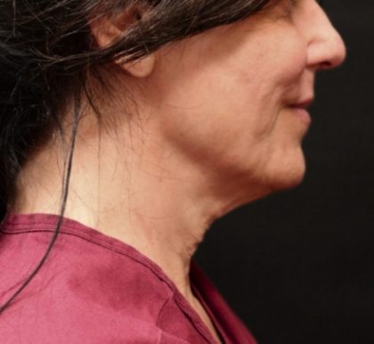 Scarless Facelift and Necklift Before & After Patient #11105