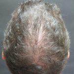 Hair Restoration Before & After Patient #11146