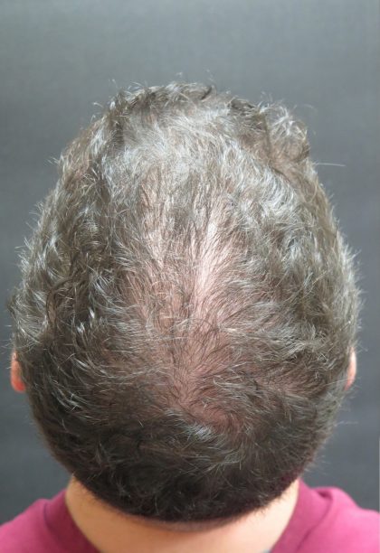 Hair Restoration Before & After Patient #11146