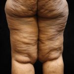 Thigh Lift Before & After Patient #10847