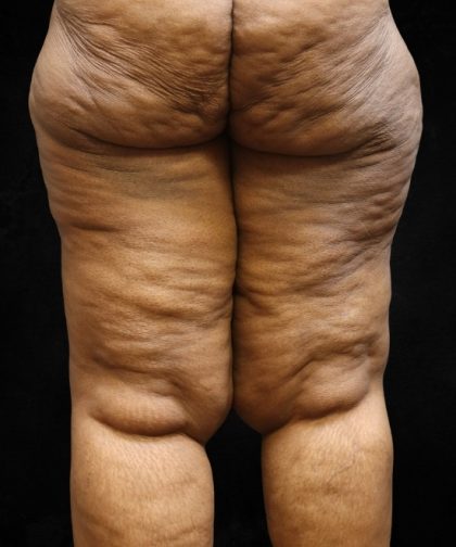 Thigh Lift Before & After Patient #10847