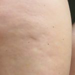 Cellulite Treatment Before & After Patient #10859