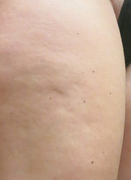 Cellulite Treatment Before & After Patient #10859