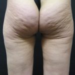 Cellulite Treatment Before & After Patient #10861