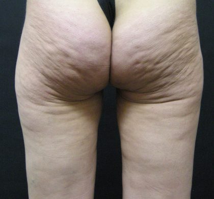 Cellulite Treatment Before & After Patient #10861
