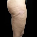 Cellulite Treatment Before & After Patient #10862