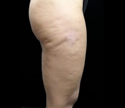Cellulite Treatment Before & After Patient #10862