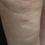 Cellulite Treatment Before & After Patient #10863