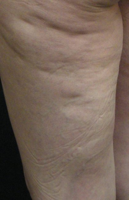 Cellulite Treatment Before & After Patient #10863
