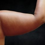 Arm Lift Before & After Patient #10814