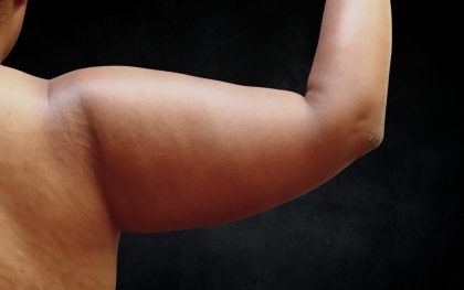 Arm Lift Before & After Patient #10814