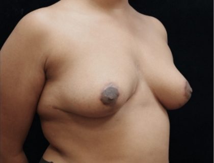 Breast Asymmetry Before & After Patient #10901