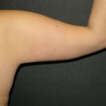 Arm Lift Before & After Patient #10812