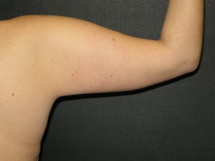 Arm Lift Before & After Patient #10812