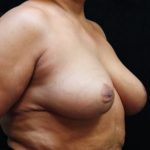 Breast Asymmetry Before & After Patient #10903