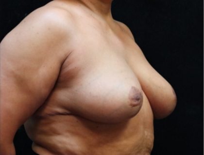 Breast Asymmetry Before & After Patient #10903