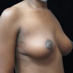 Breast Lift Before & After Patient #11044