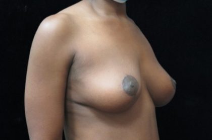 Breast Lift Before & After Patient #11044