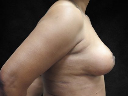 Breast Lift Before & After Patient #11045
