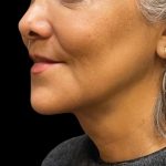 Scarless Facelift and Necklift Before & After Patient #11100
