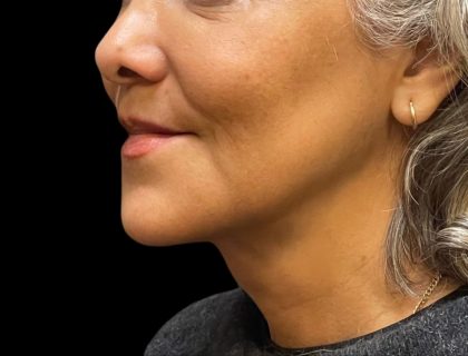 Scarless Facelift and Necklift Before & After Patient #11100